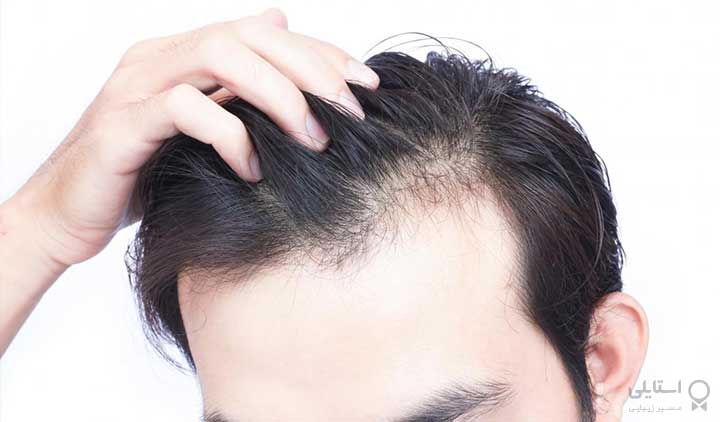 علل و درمان های ریزش مو