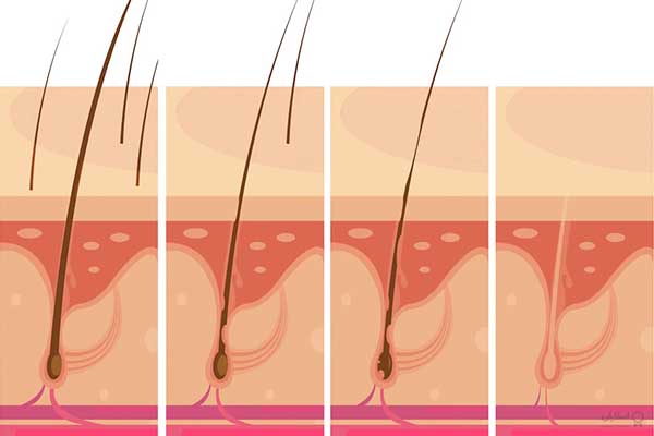 ریزش مو و تنبلی تخمدان: علل، علائم و درمان