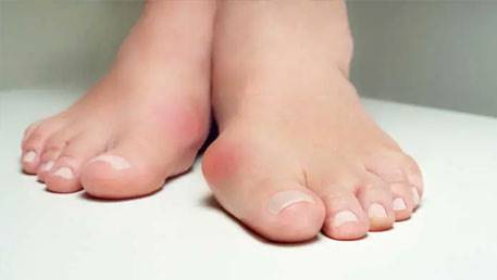 انحراف شست پا را به روش طبیعی درمان کنید