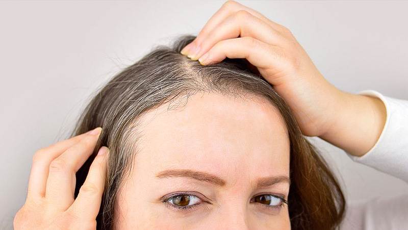 8 روش خانگی برای خلاصی از سفیدی زودرس مو