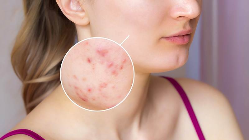 23 درمان خانگی مؤثر برای عفونت پوست