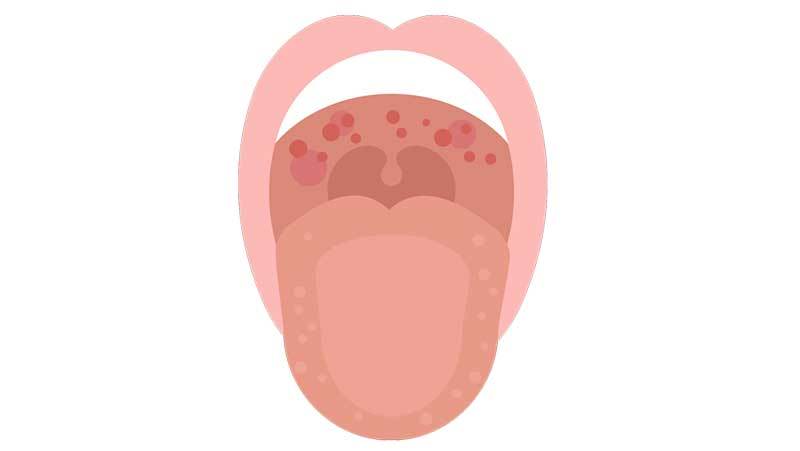 متورم شدن زبان کوچک: علل، علائم و 8 درمان خانگی