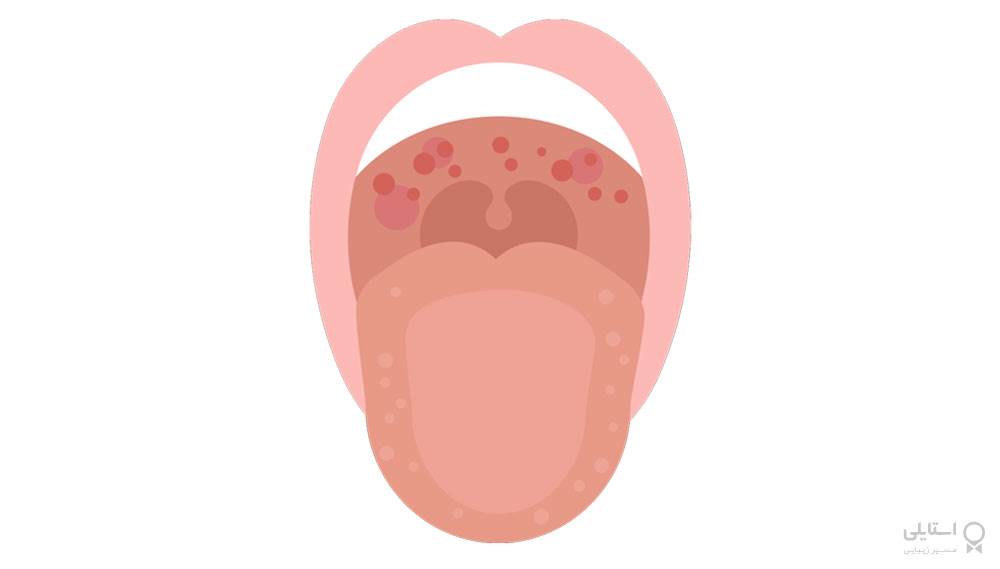 متورم شدن زبان کوچک: علل، علائم و 8 درمان خانگی